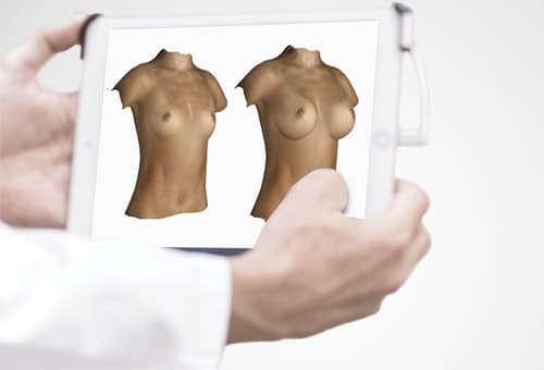 Simulation avant après d'une augmentation mammaire en 3D