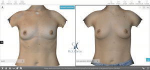 Modélisation 3D augmentation mammaire par transfert de graisse autologue vue de face patiente 2
