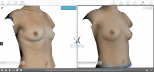 Modélisation 3D augmentation mammaire par transfert de graisse autologue vue de profil patiente 2