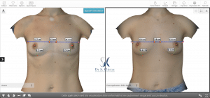 Modélisation 3D augmentation mammaire par transfert de graisse autologue mesures patiente 2