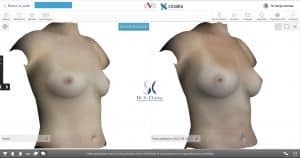 Modélisation 3D augmentation mammaire par transfert de graisse autologue vue de profil patiente 1