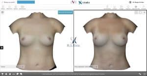 Modélisation 3D augmentation mammaire par transfert de graisse autologue vue de face patiente 1