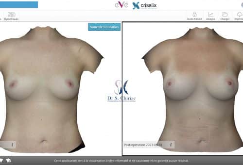 modélisation 3D augmentation mammaire
