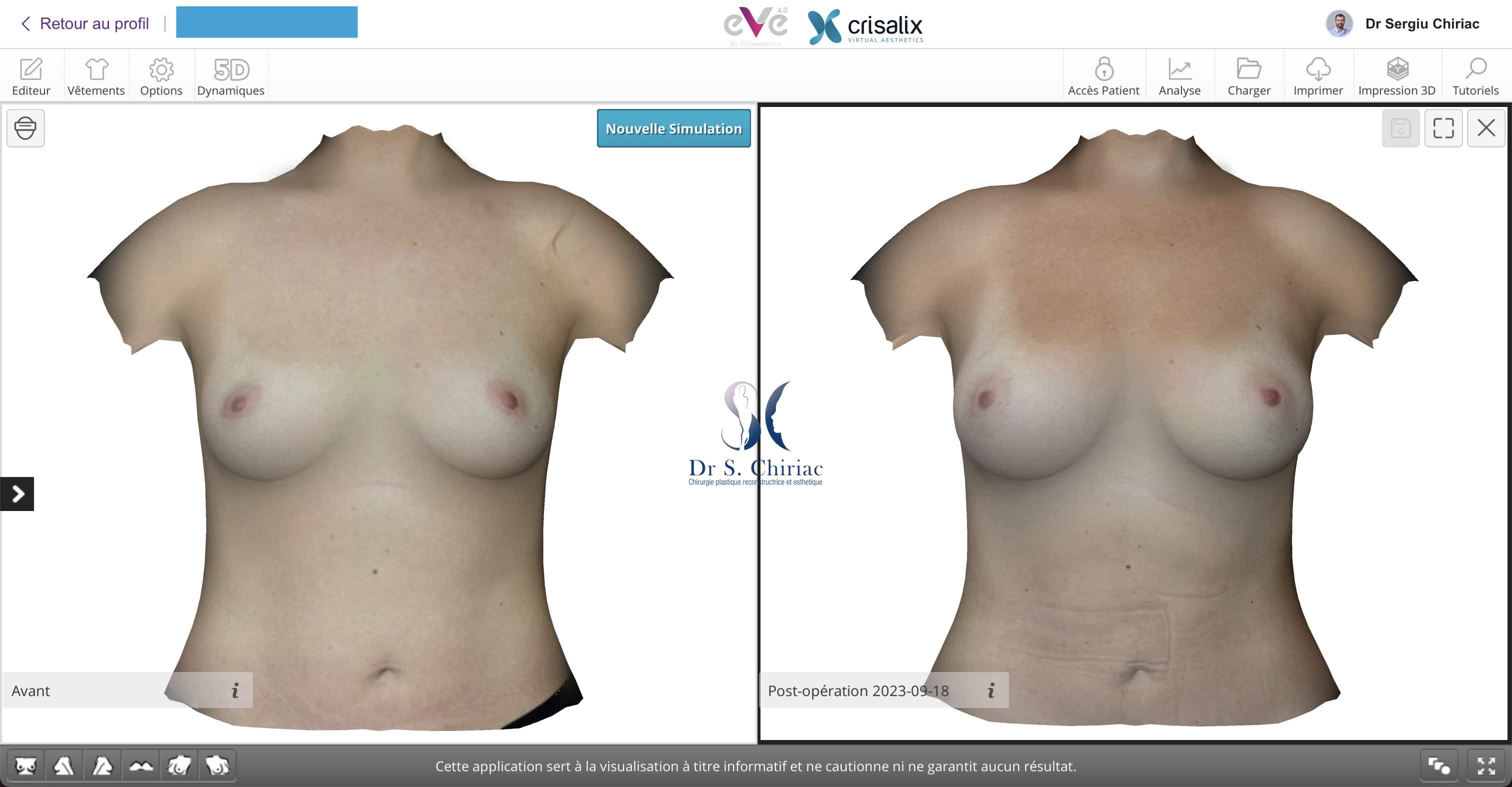 modélisation 3D augmentation mammaire