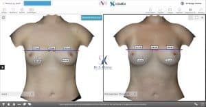 Modélisation 3D augmentation mammaire par transfert de graisse autologue mesures patiente 1