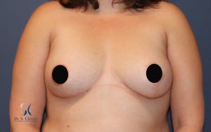 Asymétrie mammaire sévère