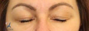 Blépharoplastie supérieure - femme