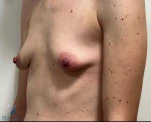 avant pose prothèses mammaires